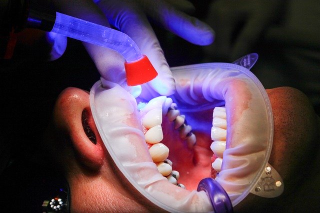 Diş hekimlerine göre en iyi 10 evde diş beyazlatma seti